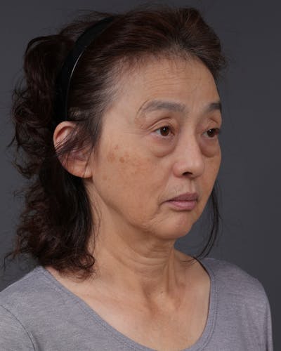 Co2 Laser Before & After Gallery - Patient 377235 - Image 1