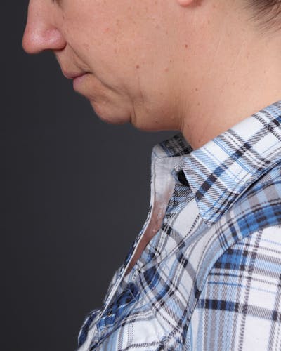 Neck Lift Before & After Gallery - Patient 261911 - Image 1