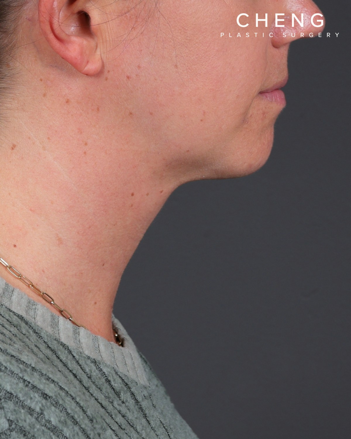 Neck Lift Before & After Gallery - Patient 261911 - Image 8