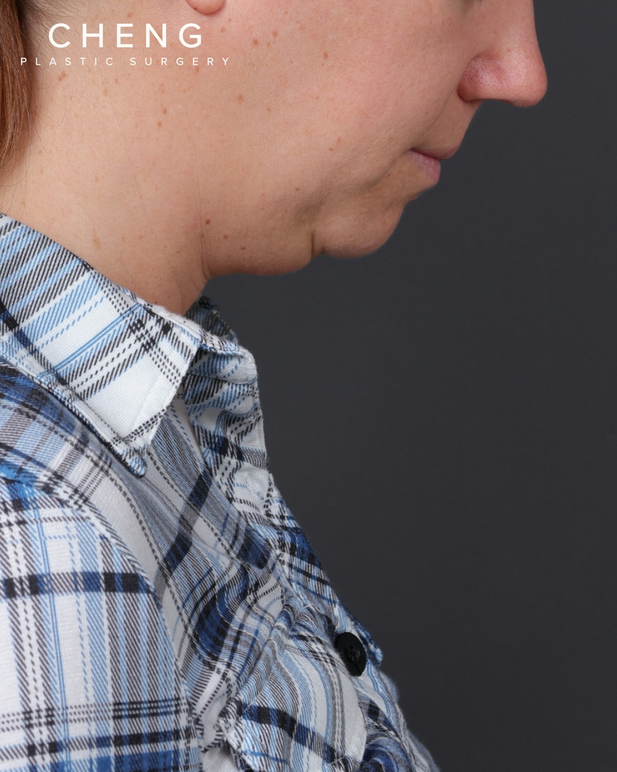 Neck Lift Before & After Gallery - Patient 261911 - Image 5