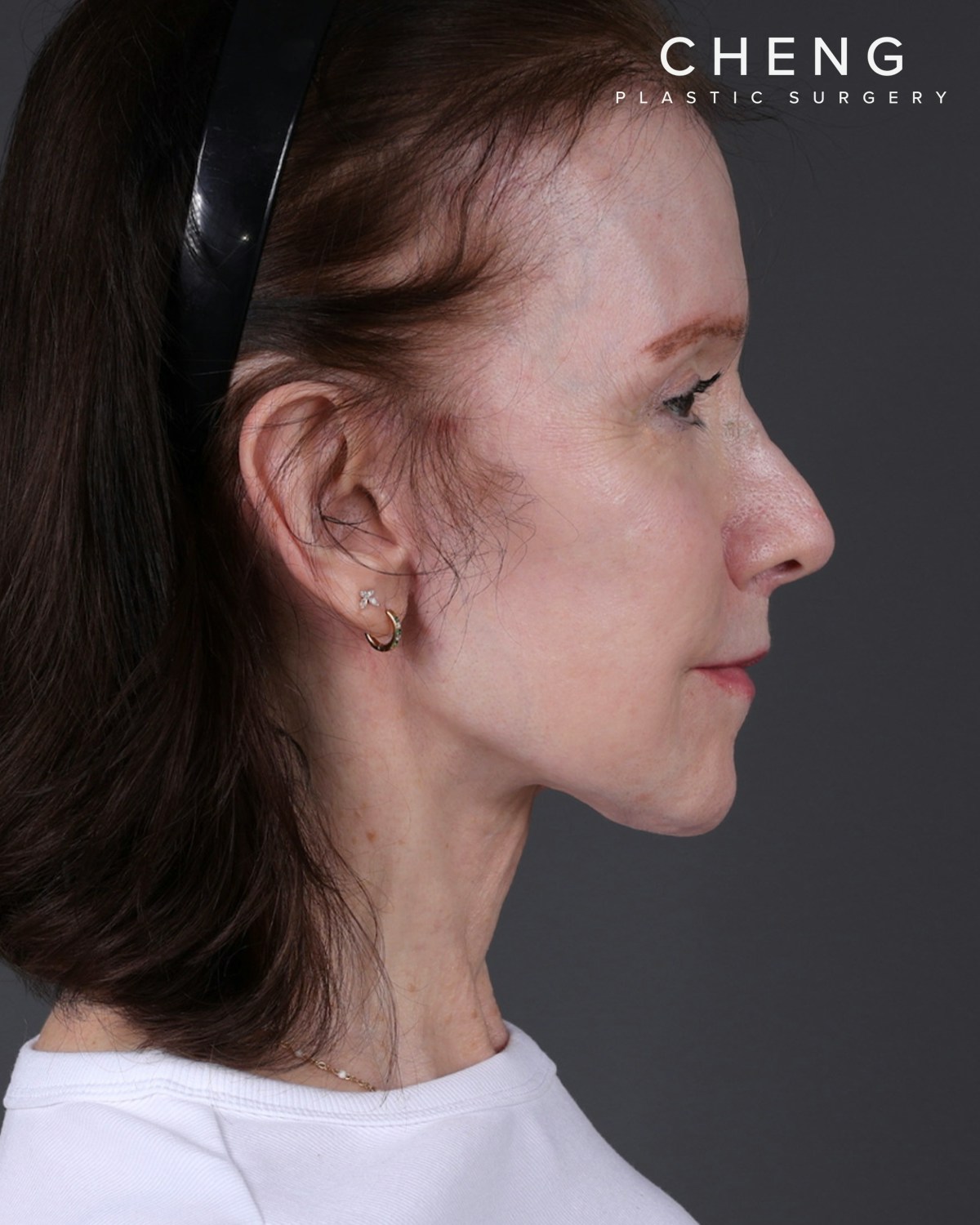 Facelift Before & After Gallery - Patient 681791 - Image 2