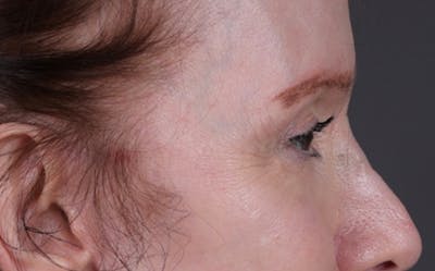 Brow Lift Before & After Gallery - Patient 147613 - Image 2