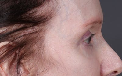 Brow Lift Before & After Gallery - Patient 147613 - Image 1