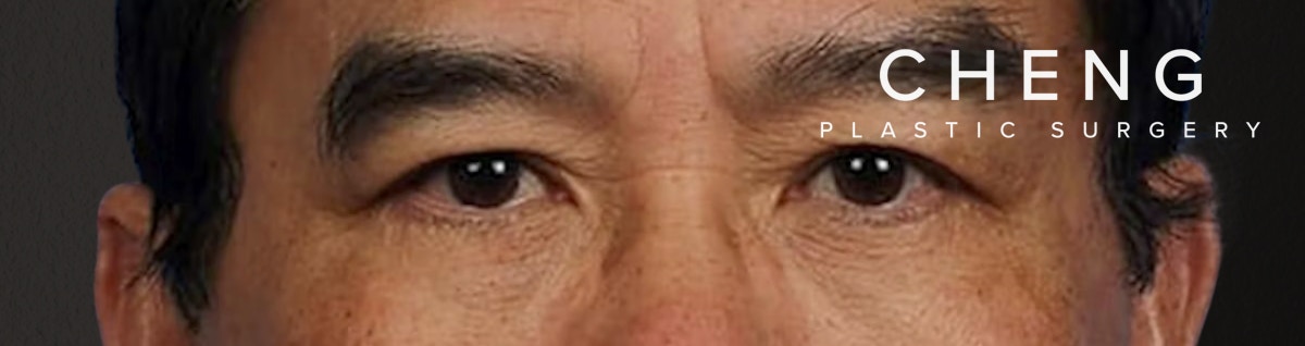 Blepharoplasty Before & After Gallery - Patient 232957 - Image 2