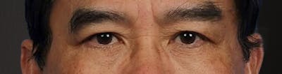 Blepharoplasty Before & After Gallery - Patient 232957 - Image 2