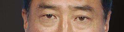 Blepharoplasty Before & After Gallery - Patient 481320 - Image 1