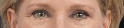 Blepharoplasty Before & After Gallery - Patient 216006 - Image 2