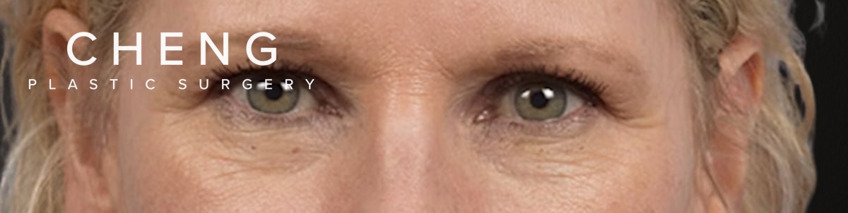 Blepharoplasty Before & After Gallery - Patient 216006 - Image 1