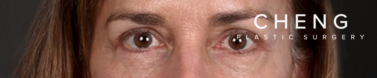 Blepharoplasty Before & After Gallery - Patient 195497 - Image 2