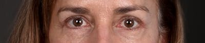 Blepharoplasty Before & After Gallery - Patient 195497 - Image 2