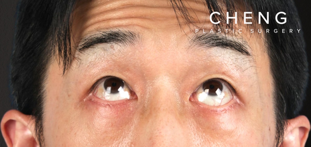 Blepharoplasty Before & After Gallery - Patient 659679 - Image 2