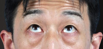 Blepharoplasty Before & After Gallery - Patient 659679 - Image 1