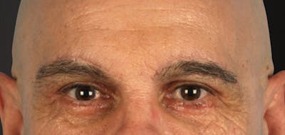 Blepharoplasty Before & After Gallery - Patient 309869 - Image 2