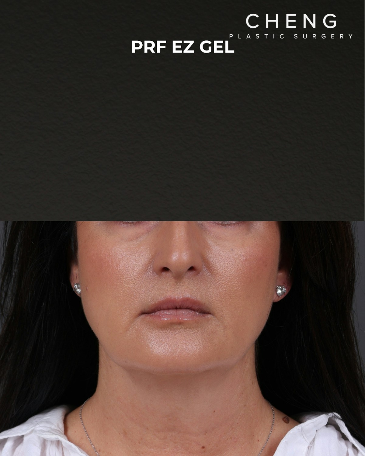 Dermal Fillers Before & After Gallery - Patient 186879 - Image 2