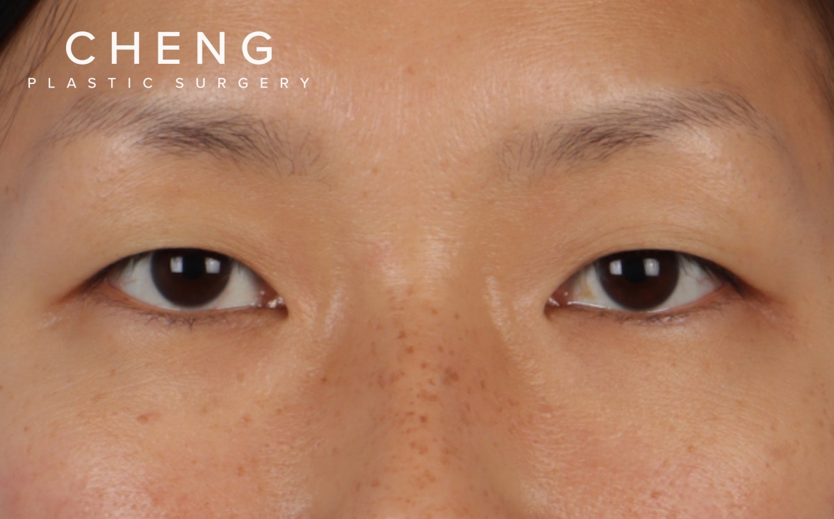 Blepharoplasty Before & After Gallery - Patient 286711 - Image 1