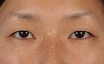 Blepharoplasty Before & After Gallery - Patient 286711 - Image 1