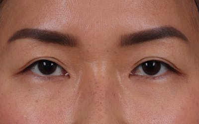 Blepharoplasty Before & After Gallery - Patient 286711 - Image 2