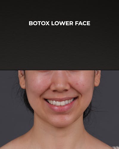 Botox and Dysport Before & After Gallery - Patient 326035 - Image 1