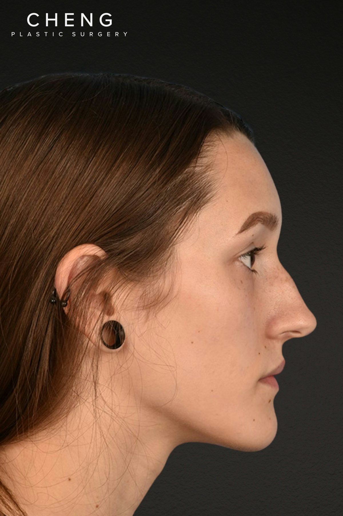 Rhinoplasty Before & After Gallery - Patient 399845 - Image 1