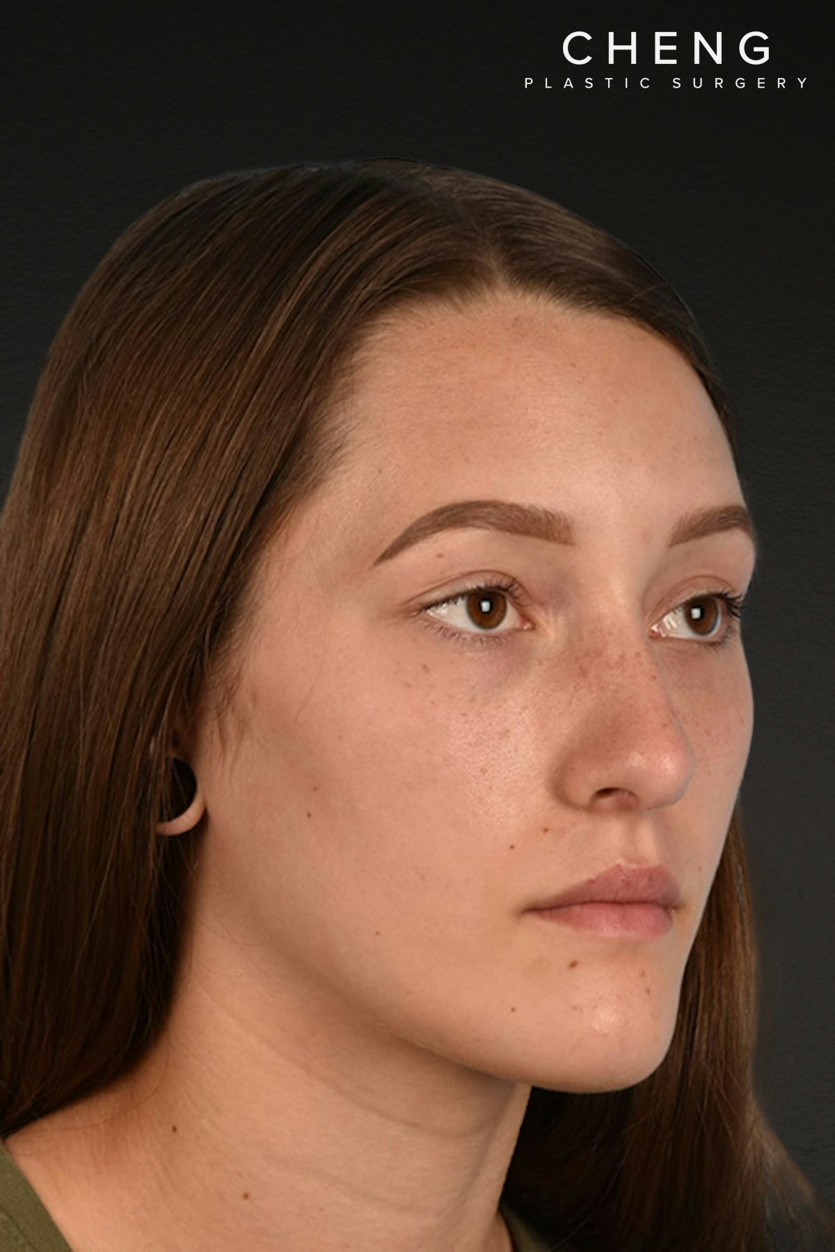 Rhinoplasty Before & After Gallery - Patient 399845 - Image 4