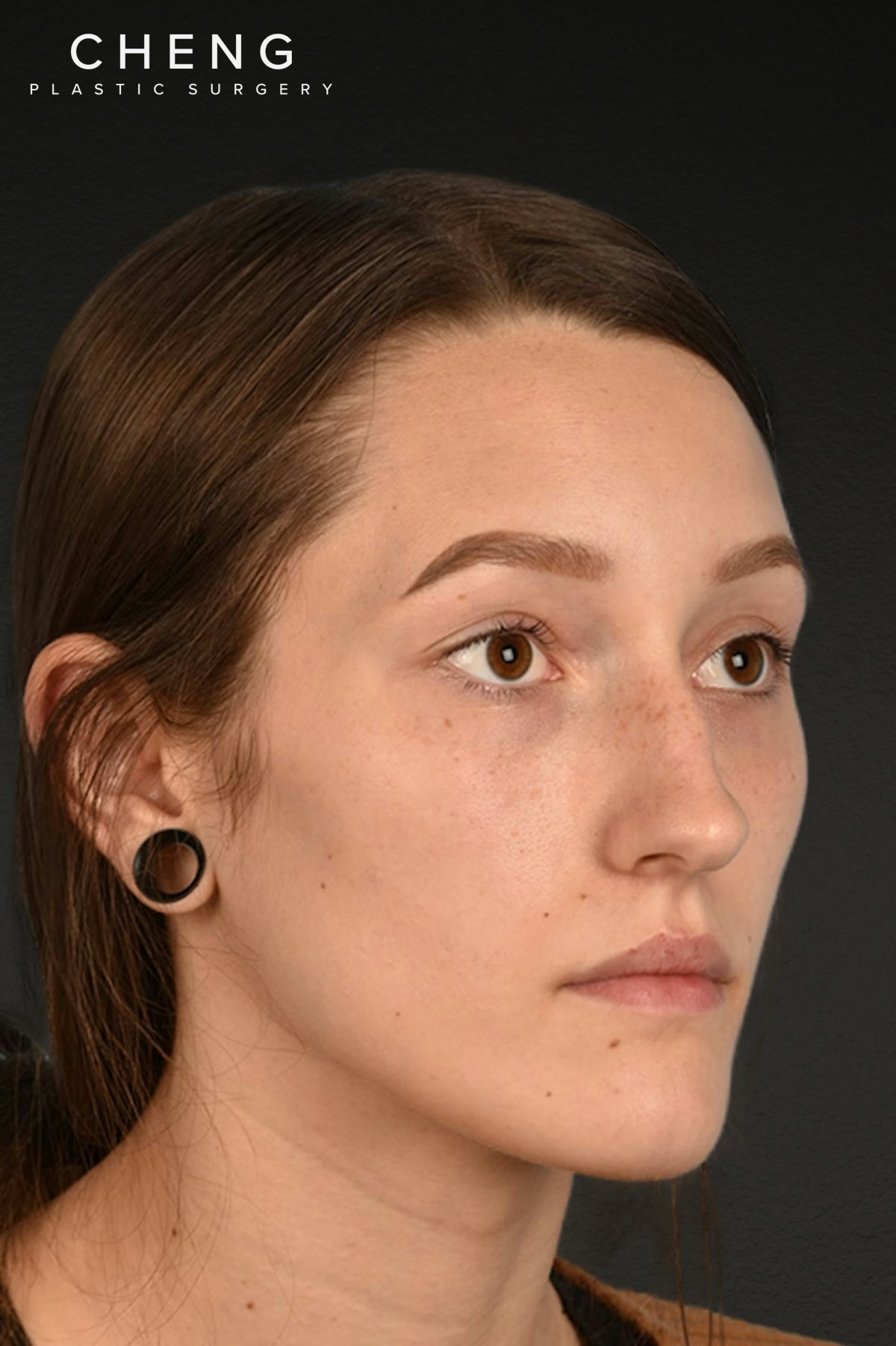 Rhinoplasty Before & After Gallery - Patient 399845 - Image 3