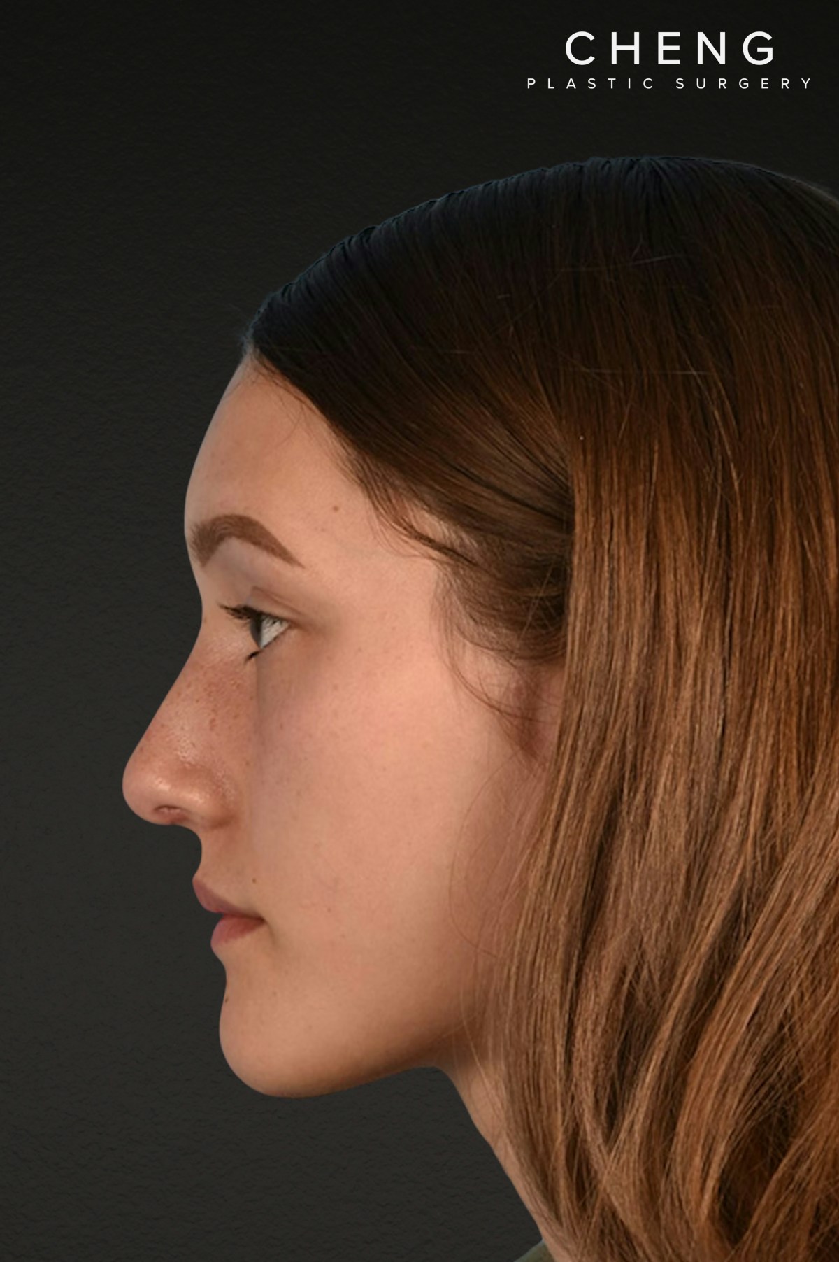 Rhinoplasty Before & After Gallery - Patient 399845 - Image 10