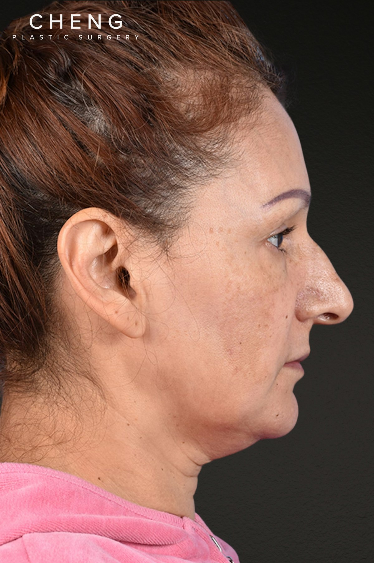 Rhinoplasty Before & After Gallery - Patient 178828 - Image 1