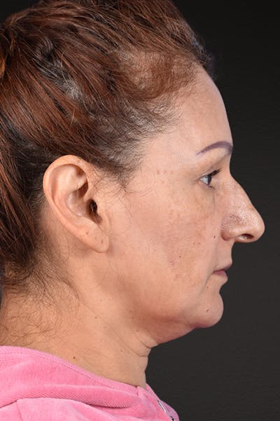 Rhinoplasty Before & After Gallery - Patient 178828 - Image 1