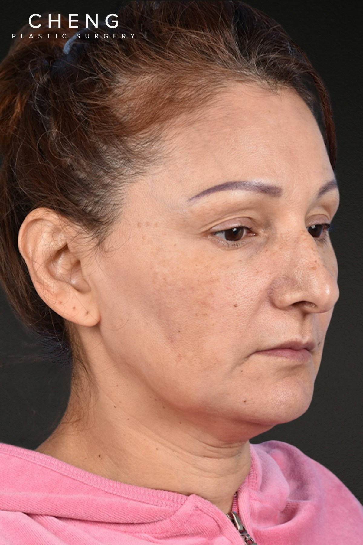 Rhinoplasty Before & After Gallery - Patient 178828 - Image 3