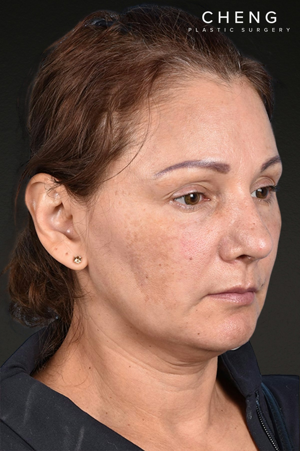Rhinoplasty Before & After Gallery - Patient 178828 - Image 4