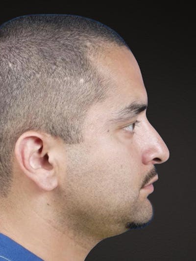 Rhinoplasty Before & After Gallery - Patient 237138 - Image 1