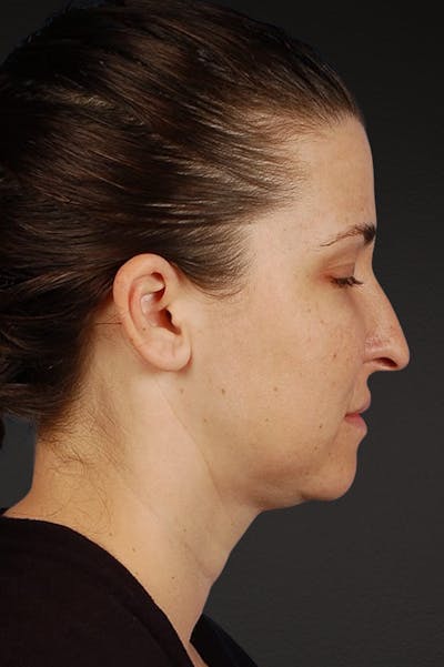 Rhinoplasty Before & After Gallery - Patient 378514 - Image 1