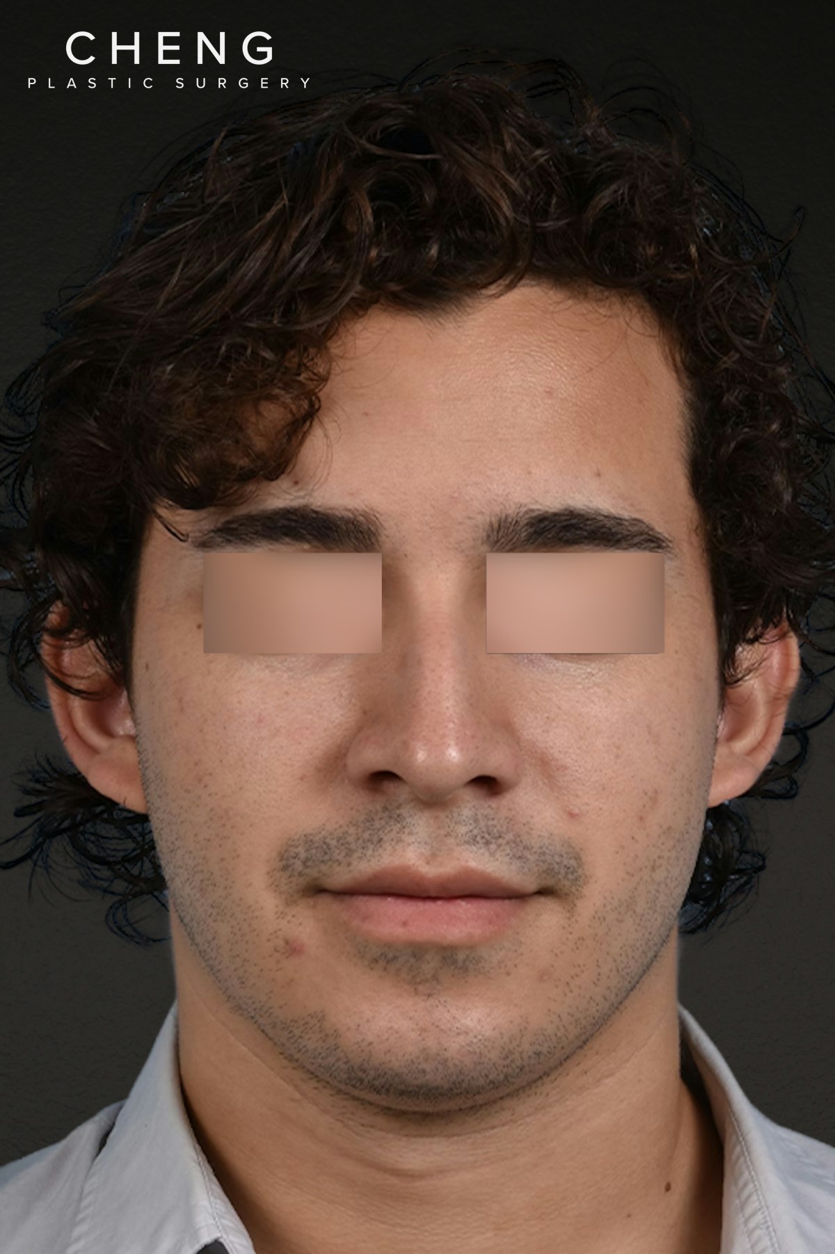Rhinoplasty Before & After Gallery - Patient 323731 - Image 9