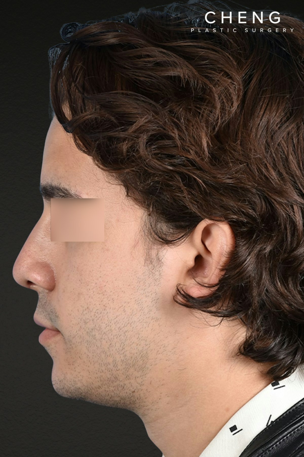 Rhinoplasty Before & After Gallery - Patient 323731 - Image 6