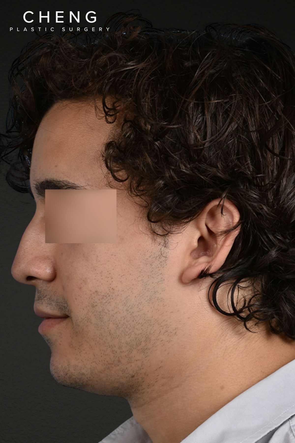 Rhinoplasty Before & After Gallery - Patient 323731 - Image 5