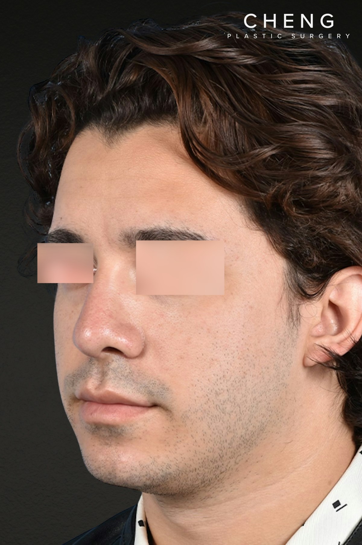 Rhinoplasty Before & After Gallery - Patient 323731 - Image 4