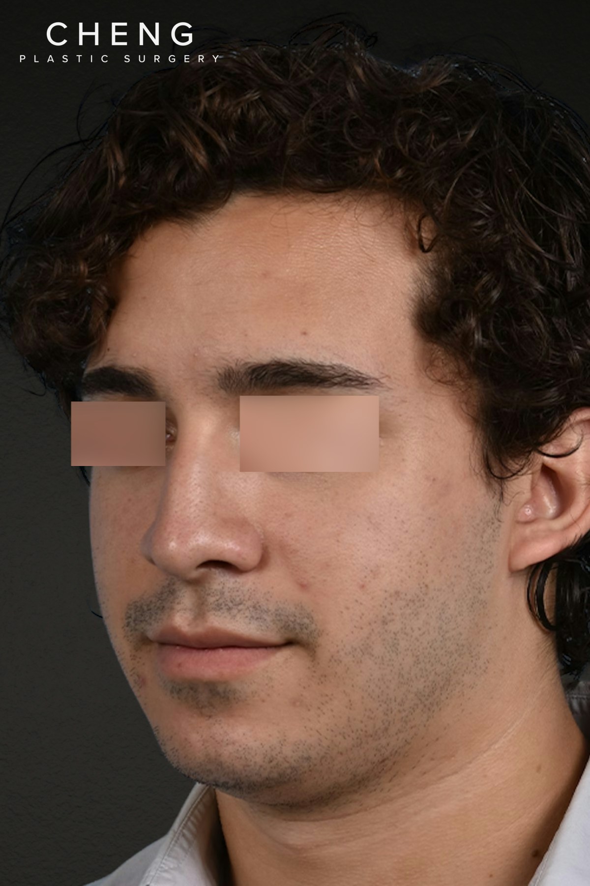 Rhinoplasty Before & After Gallery - Patient 323731 - Image 3