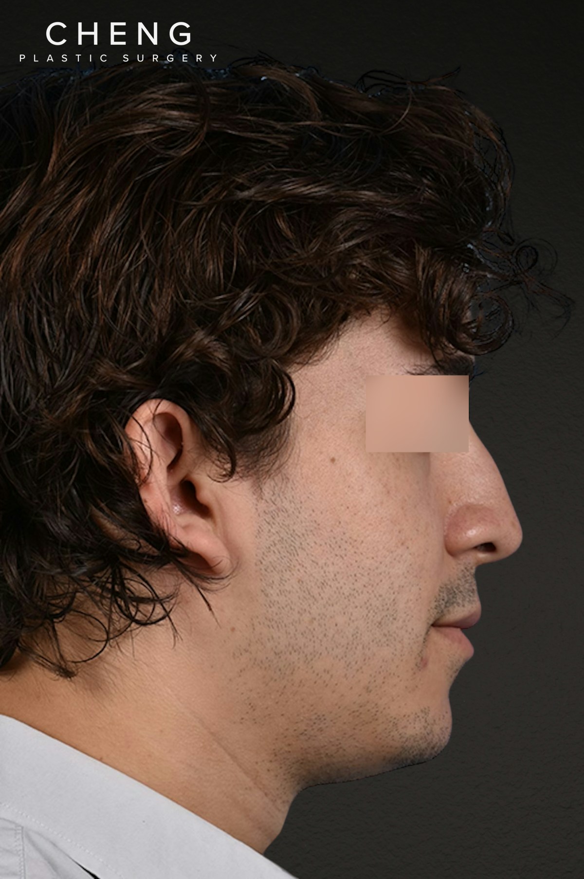 Rhinoplasty Before & After Gallery - Patient 323731 - Image 1