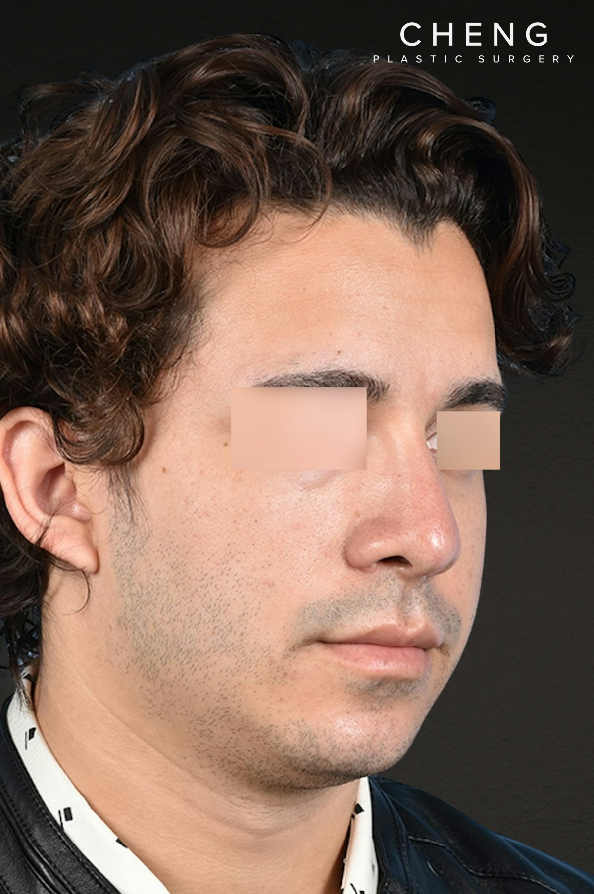 Rhinoplasty Before & After Gallery - Patient 323731 - Image 8