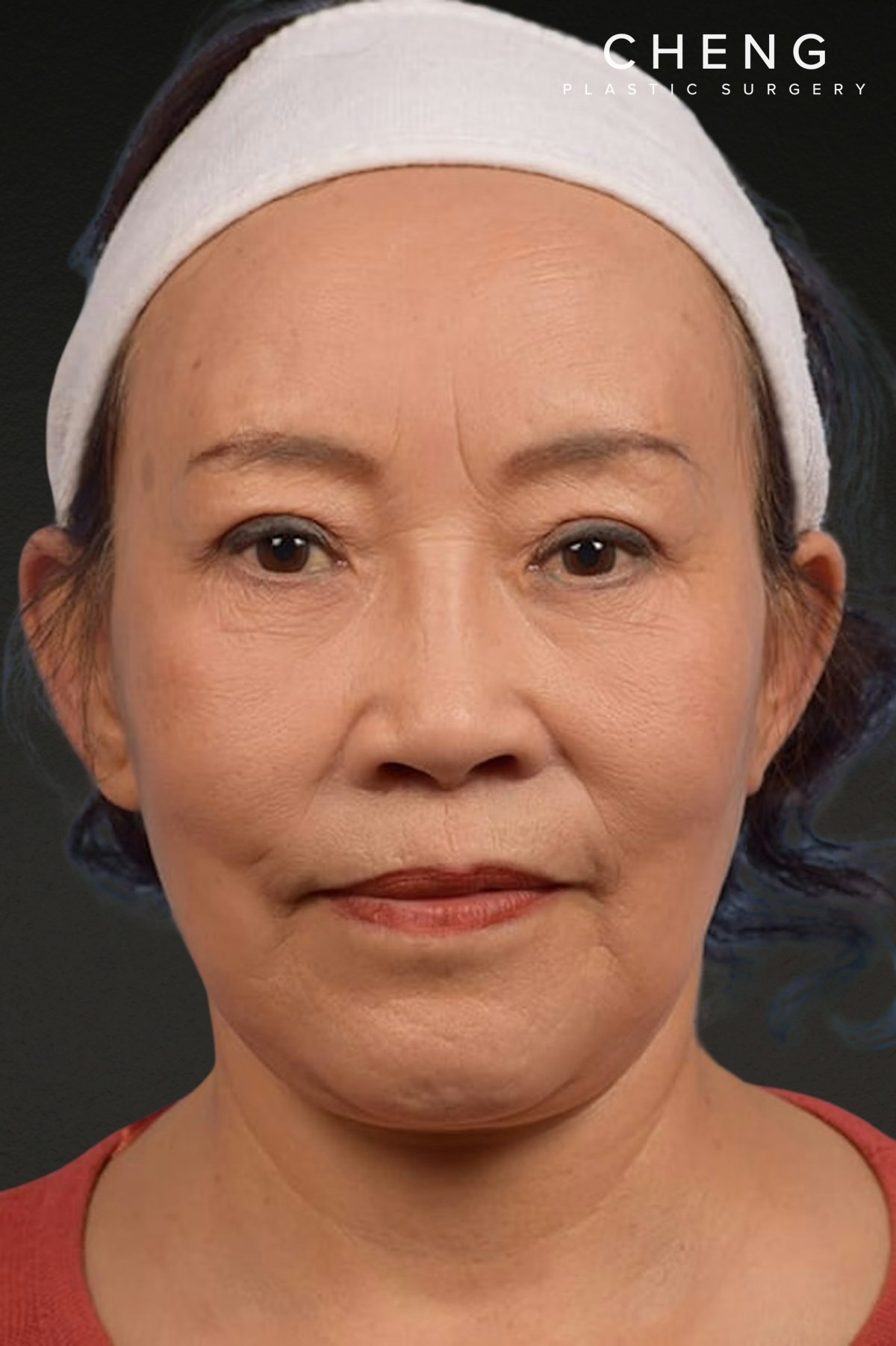Rhinoplasty Before & After Gallery - Patient 115275 - Image 6