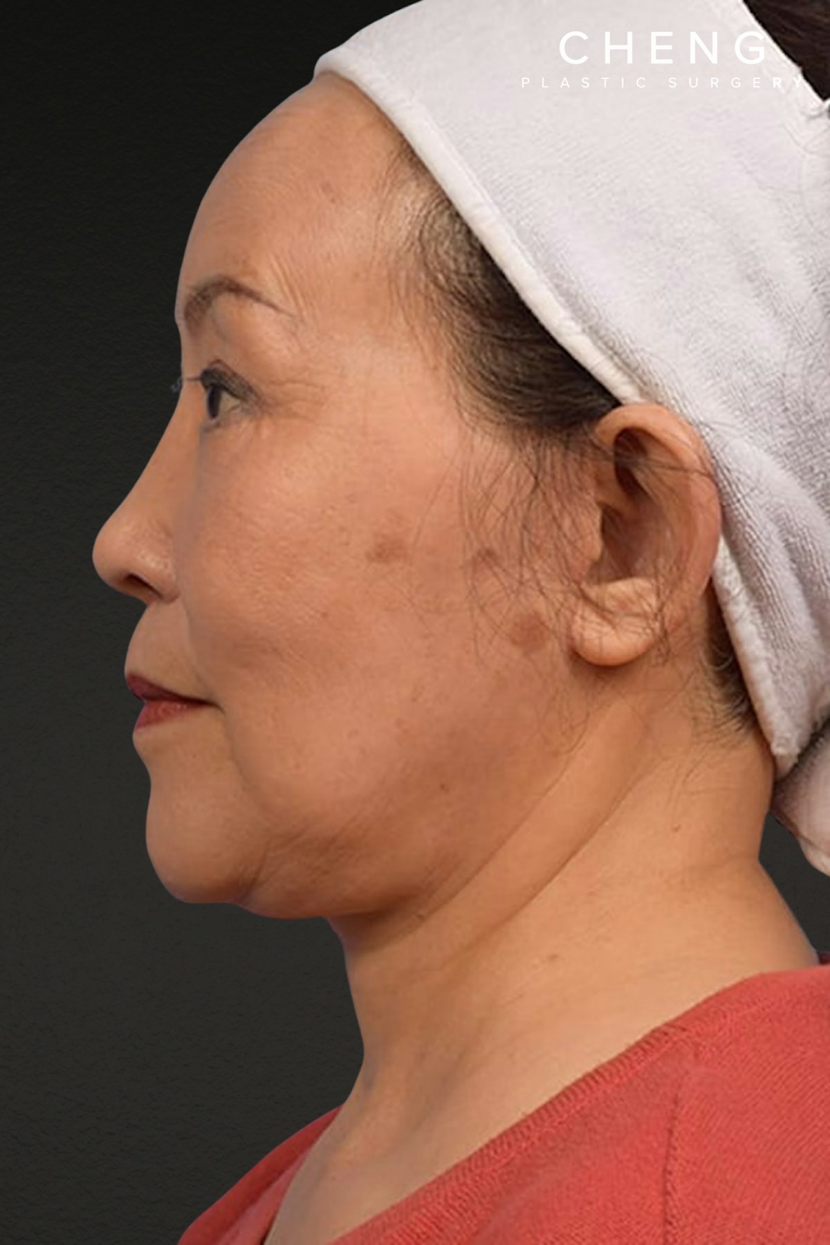 Rhinoplasty Before & After Gallery - Patient 115275 - Image 2