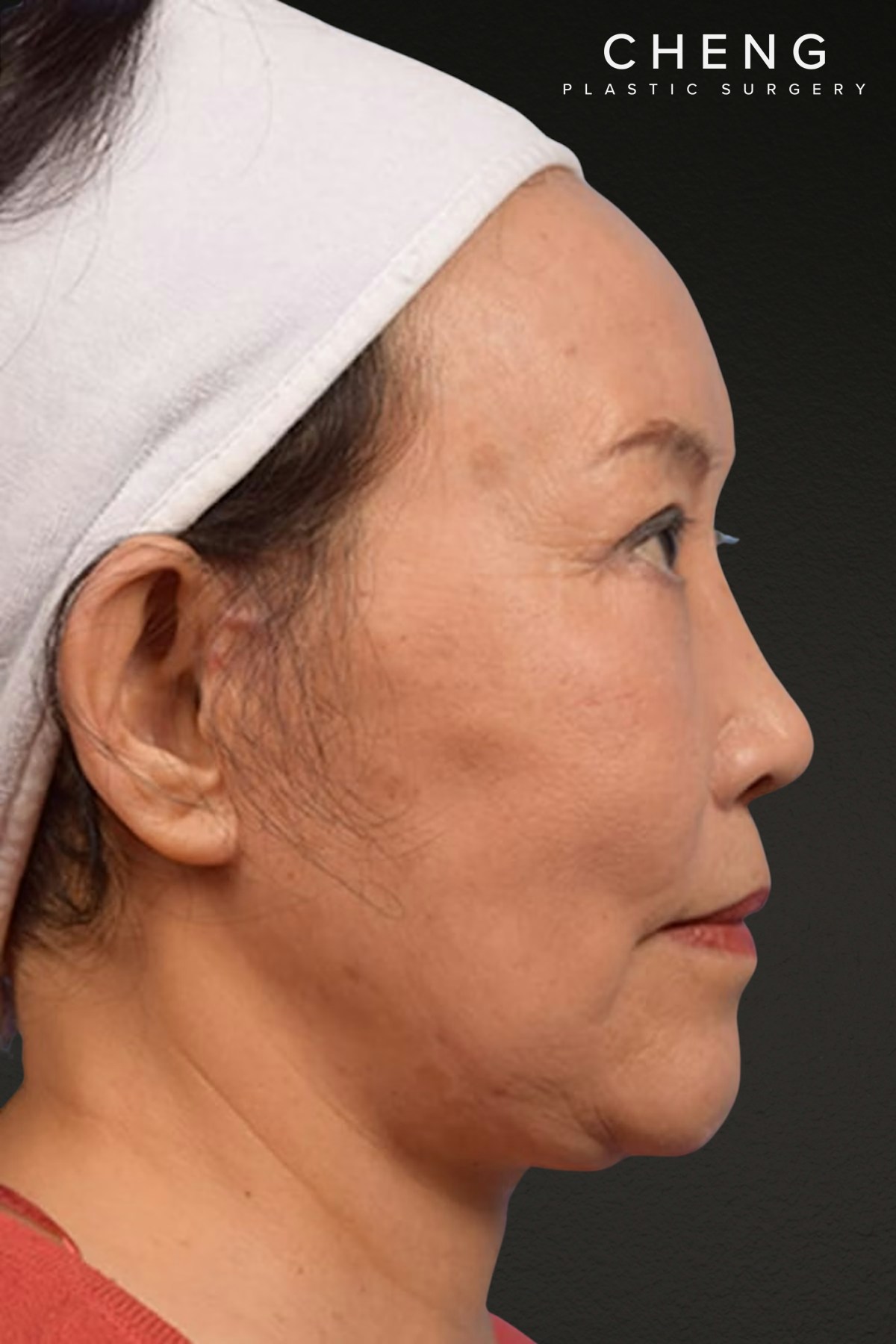 Rhinoplasty Before & After Gallery - Patient 115275 - Image 4