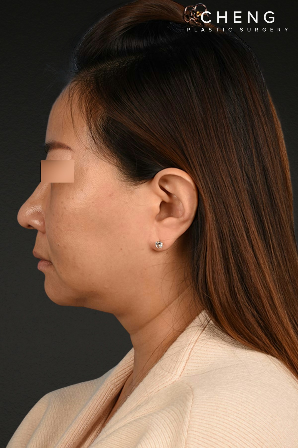 Rhinoplasty Before & After Gallery - Patient 403670 - Image 2