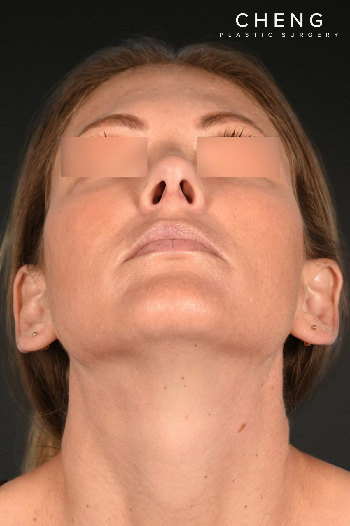 Rhinoplasty Before & After Gallery - Patient 117002 - Image 6