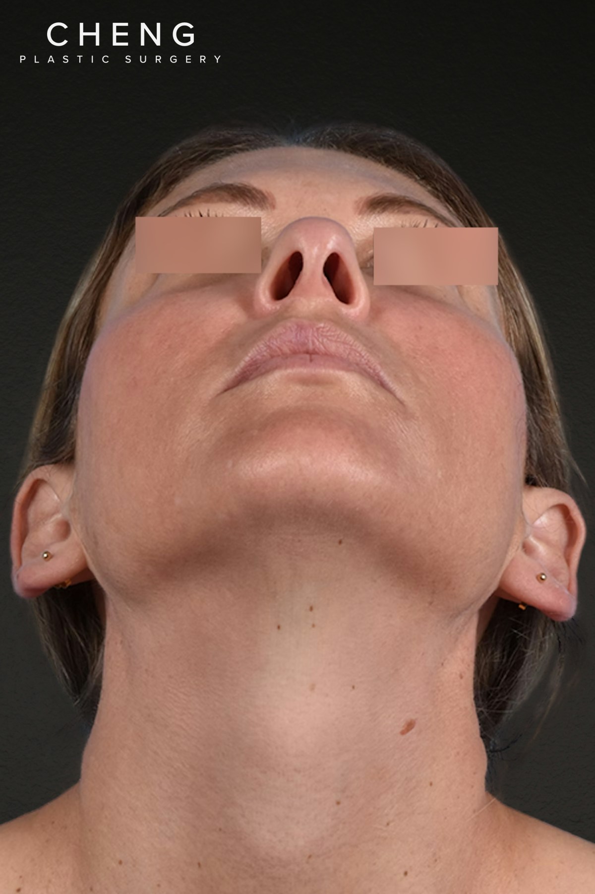 Rhinoplasty Before & After Gallery - Patient 117002 - Image 5