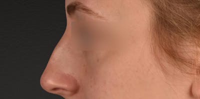 Rhinoplasty Before & After Gallery - Patient 265382 - Image 1