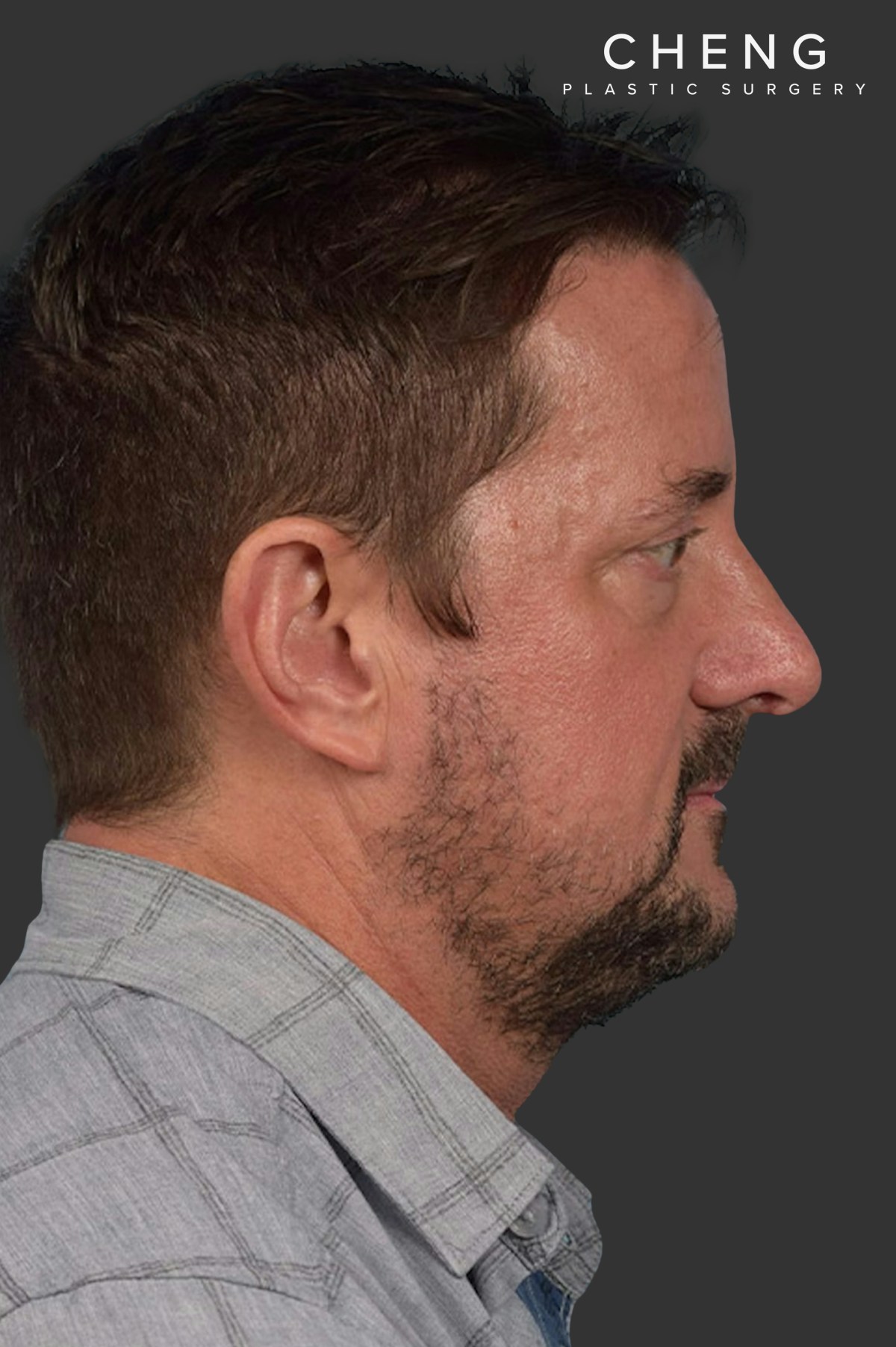 Rhinoplasty Before & After Gallery - Patient 381623 - Image 2