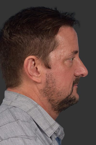 Rhinoplasty Before & After Gallery - Patient 381623 - Image 2
