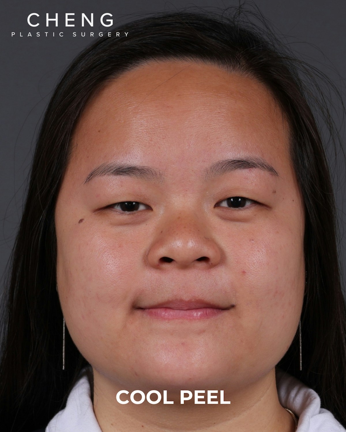 Co2 Laser Before & After Gallery - Patient 416341 - Image 5
