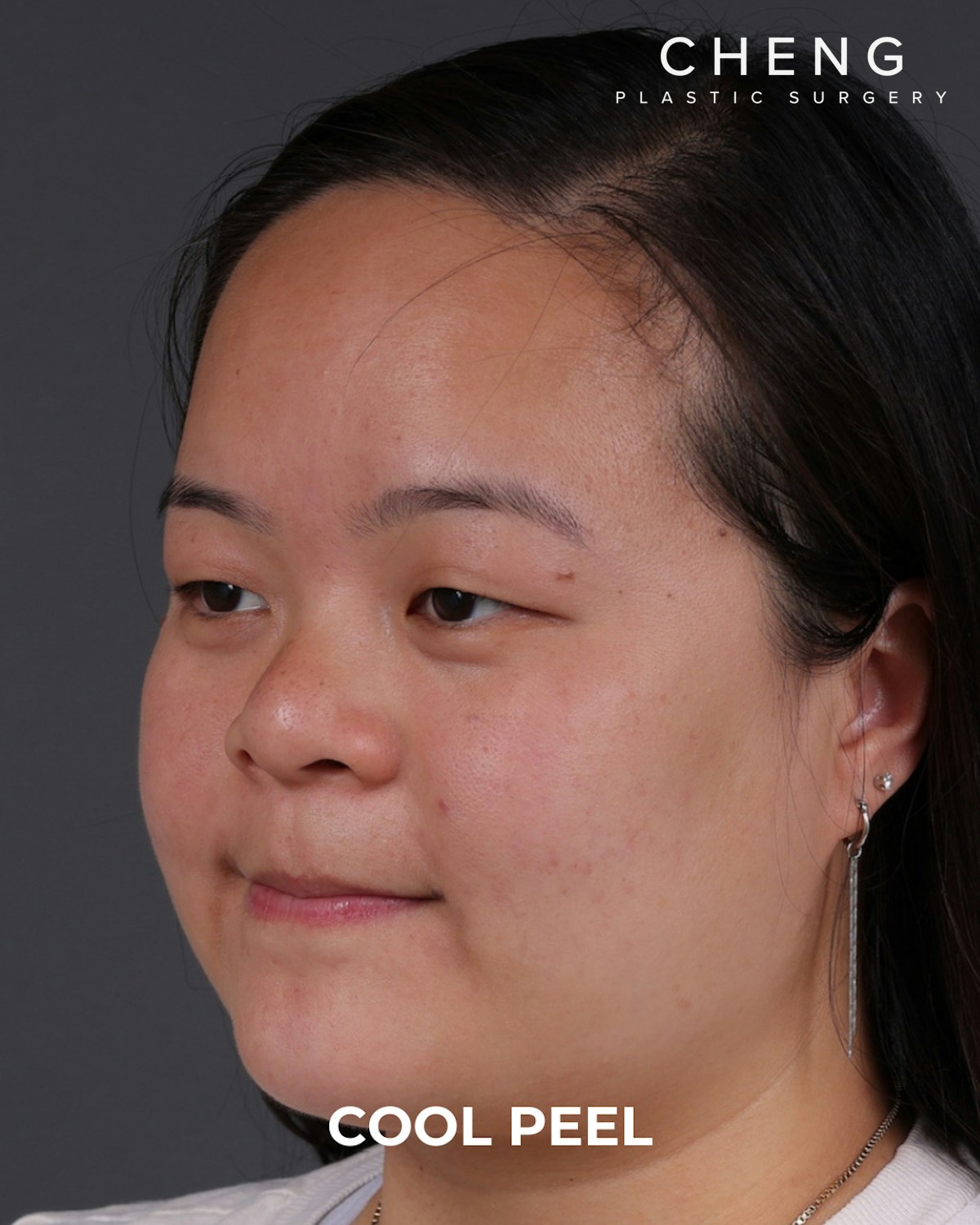 Co2 Laser Before & After Gallery - Patient 416341 - Image 8